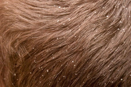 Така лупа утворюється на голові великими шматочками навколо фолікул волосся, вони травмують їх, тому ваші волосинки можуть випадати