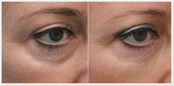 Корекція дефектів шкіри навколо очей проводиться в разі: